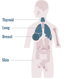 Distribution of RET gene fusions across primary tumor sites graphic